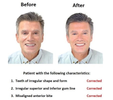 oral-rehabilitation-smiles-peru-case-study-john
