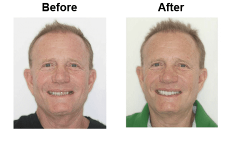Porcelain Veneers Dental Tourism Smiles Peru