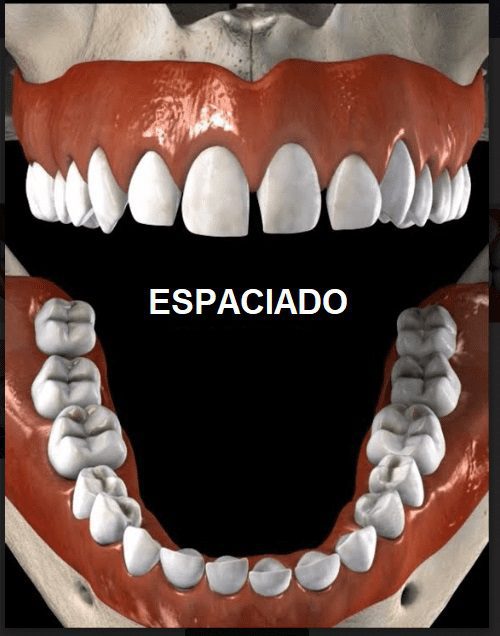 Diastema-Spacing-Dental-Smiles-Peru
