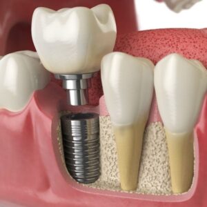 Implante Dental Smiles Peru1