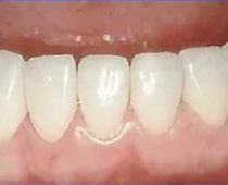 Dental Bondings-Despues