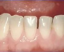 Dental Bondings-antes